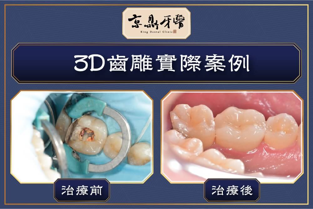 3D齒雕案例分享