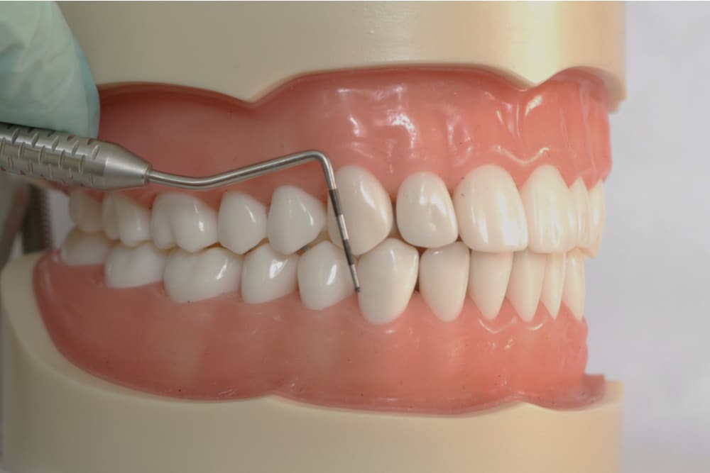 植牙失敗原因：牙周問題