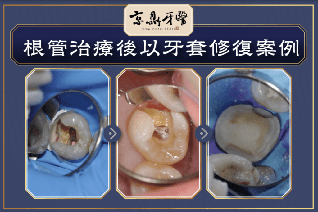 根管治療後的牙齒採用3D齒雕全瓷蓋冠體修復可保留較多自然齒質