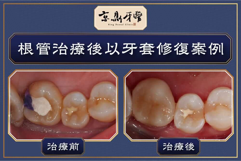 根管治療後以牙套修復案例分享