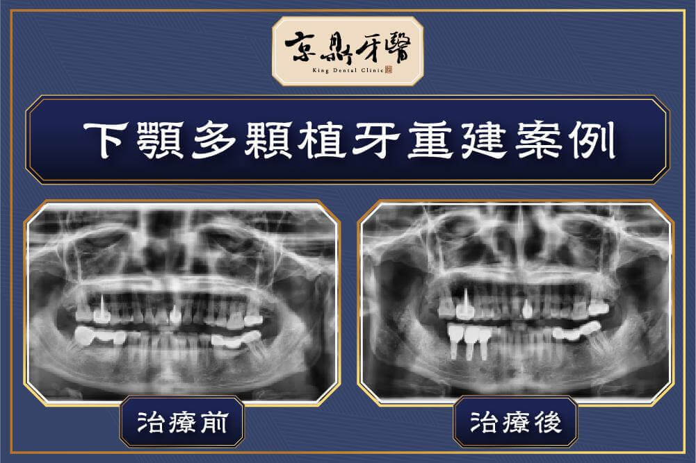 京鼎牙醫下顎多顆植牙重建案例
