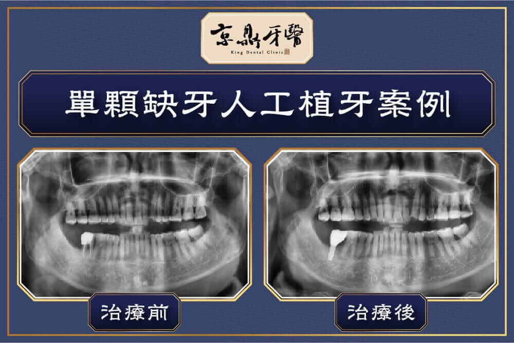 京鼎牙醫植牙案例：單顆缺牙人工植牙