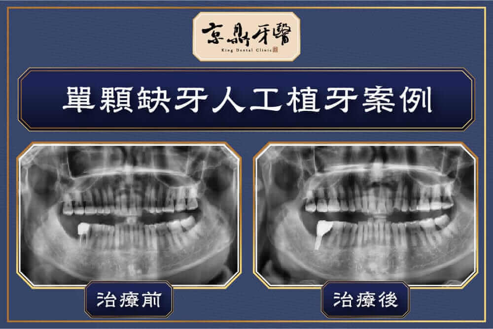 植牙過程分享：治療前後案例圖