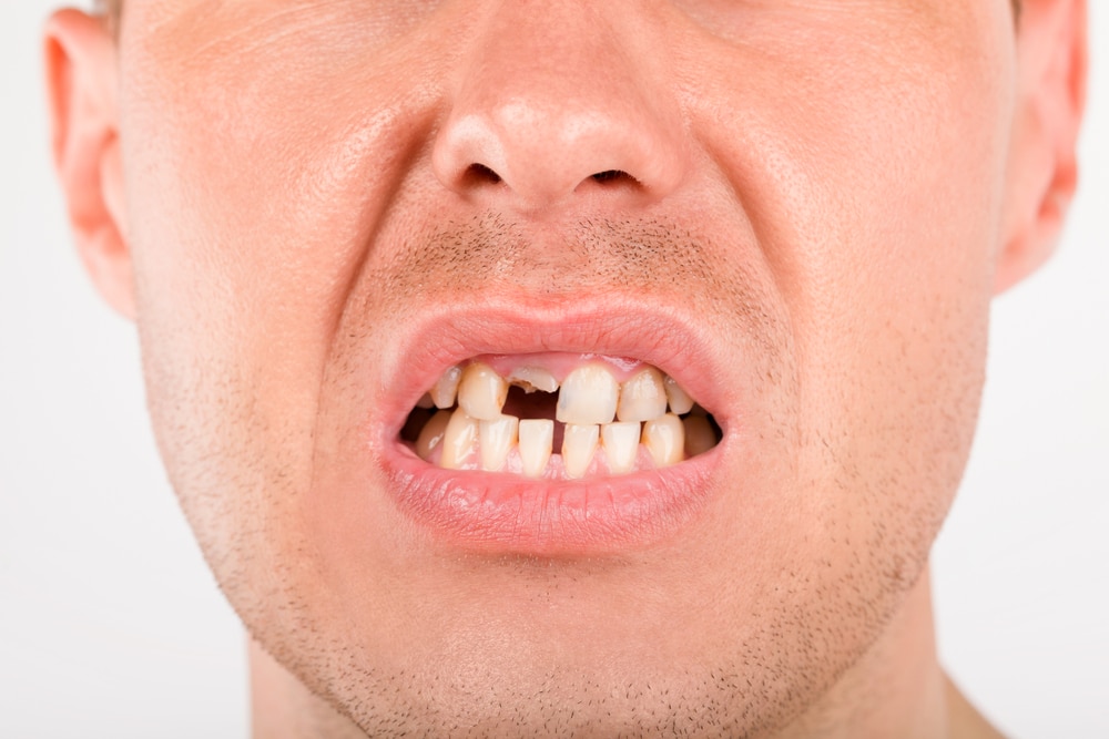 缺牙太久植牙會有困難嗎？