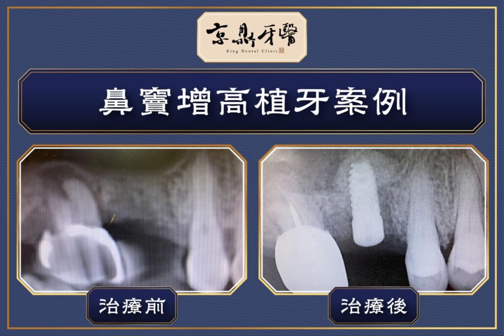 京鼎牙醫缺牙案例解析：鼻竇增高植牙手術