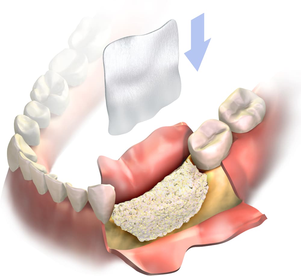 植牙補骨粉過程示意圖