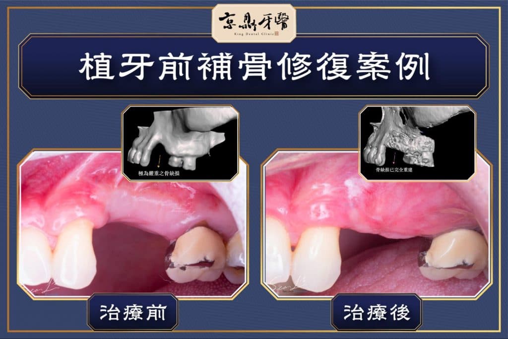 京鼎牙醫植牙補骨粉案例治療前後示意圖
