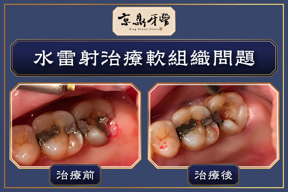 京鼎牙醫水雷射牙齦萎縮治療示意圖