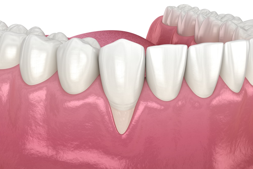牙齦萎縮怎麼辦？