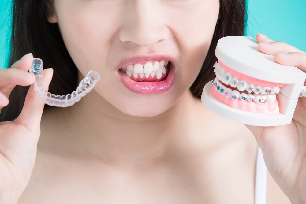 上排牙齒突出矯正方法：隱形牙套、傳統牙套