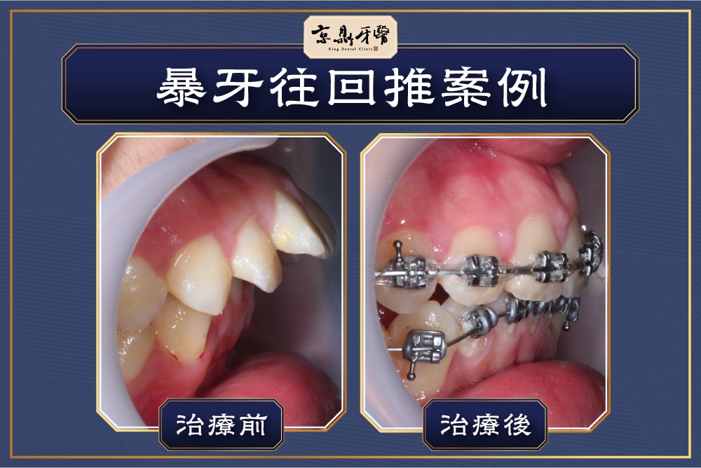 京鼎牙醫暴牙矯正案例，以矯正器將牙齒往回推