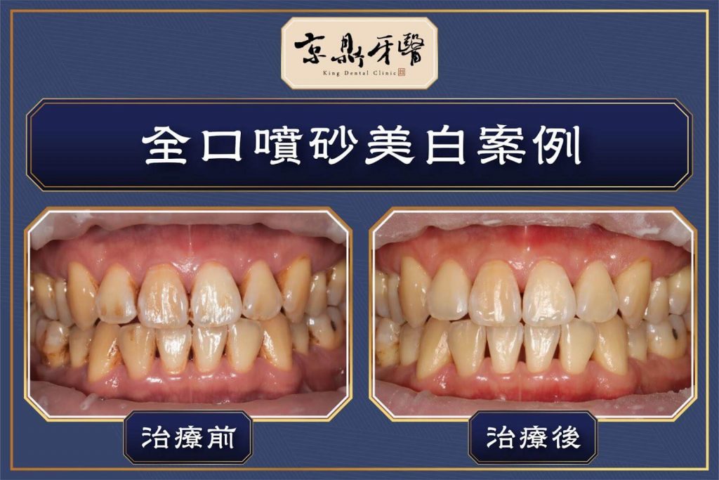 牙齒美白案例分享：噴砂美白治療前後差異