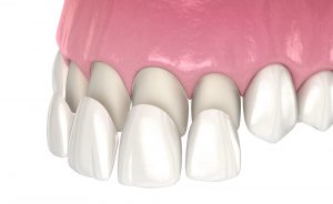 一日美齒流程會利用美齒貼片美化患者前牙區