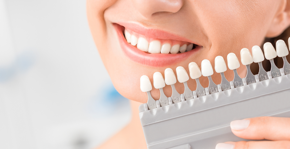 陶瓷貼片可改善前牙區牙齒美觀度