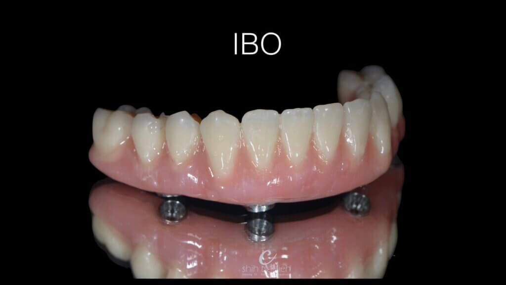 All on 4 植牙假牙：IBO (implant bar overdenture) 植體金屬桿覆蓋式義齒