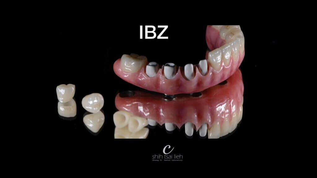All on 4 植牙假牙：專利設計假牙IBZ假牙構造