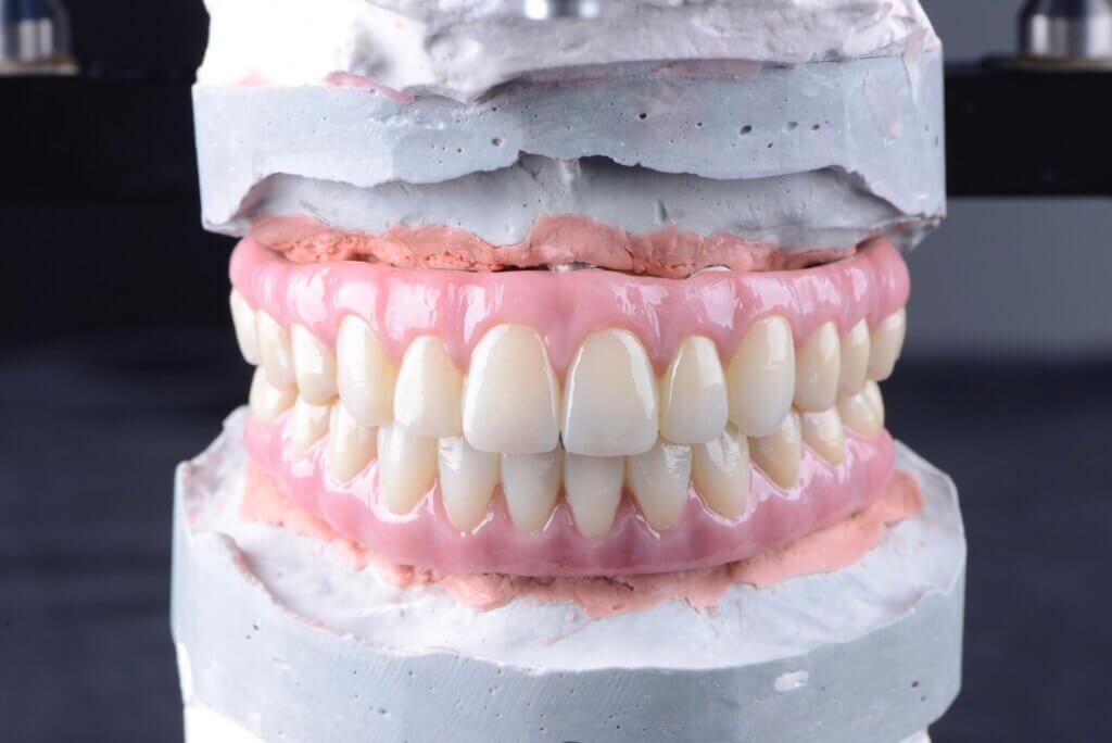 All on 4 植牙假牙：專利設計假牙IBZ樣品