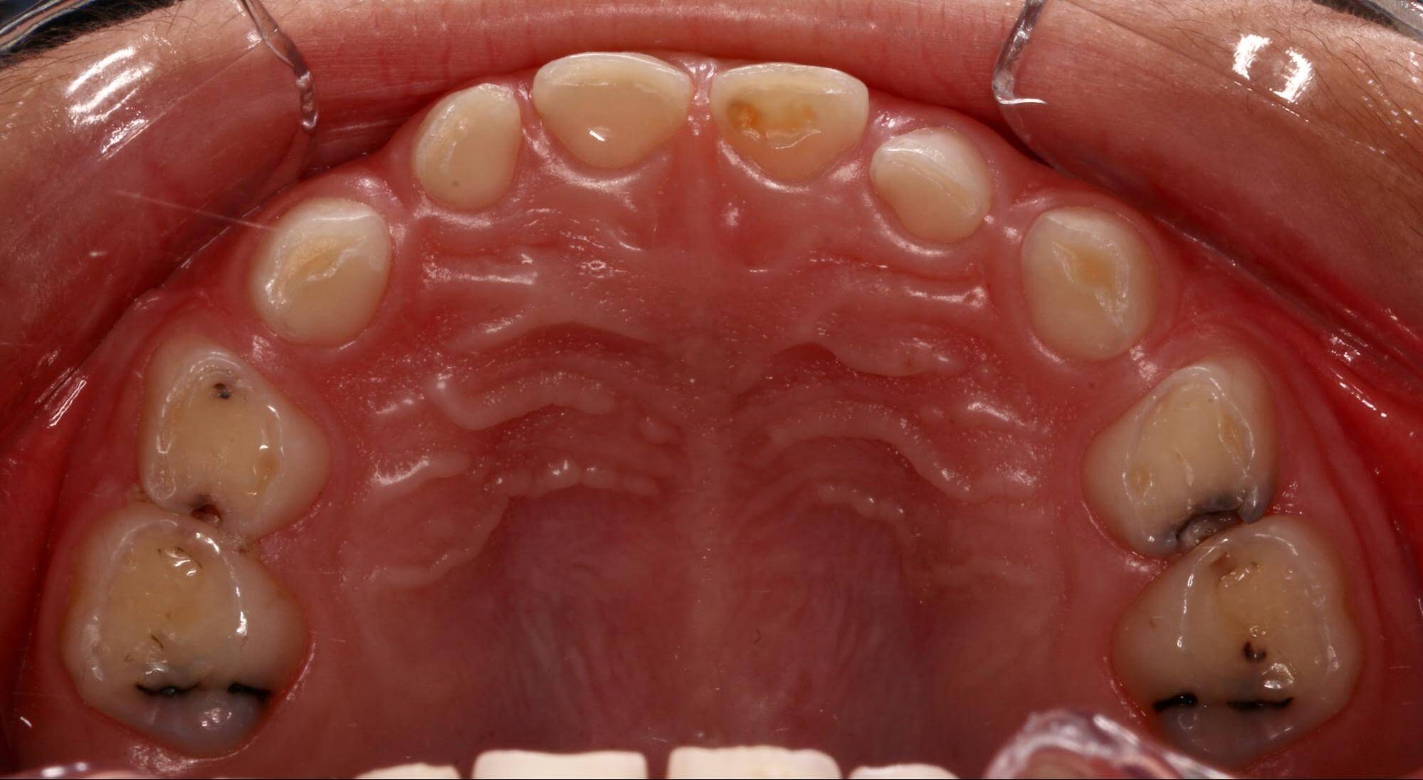小弟弟牙齒蛀牙多顆，需要進行治療