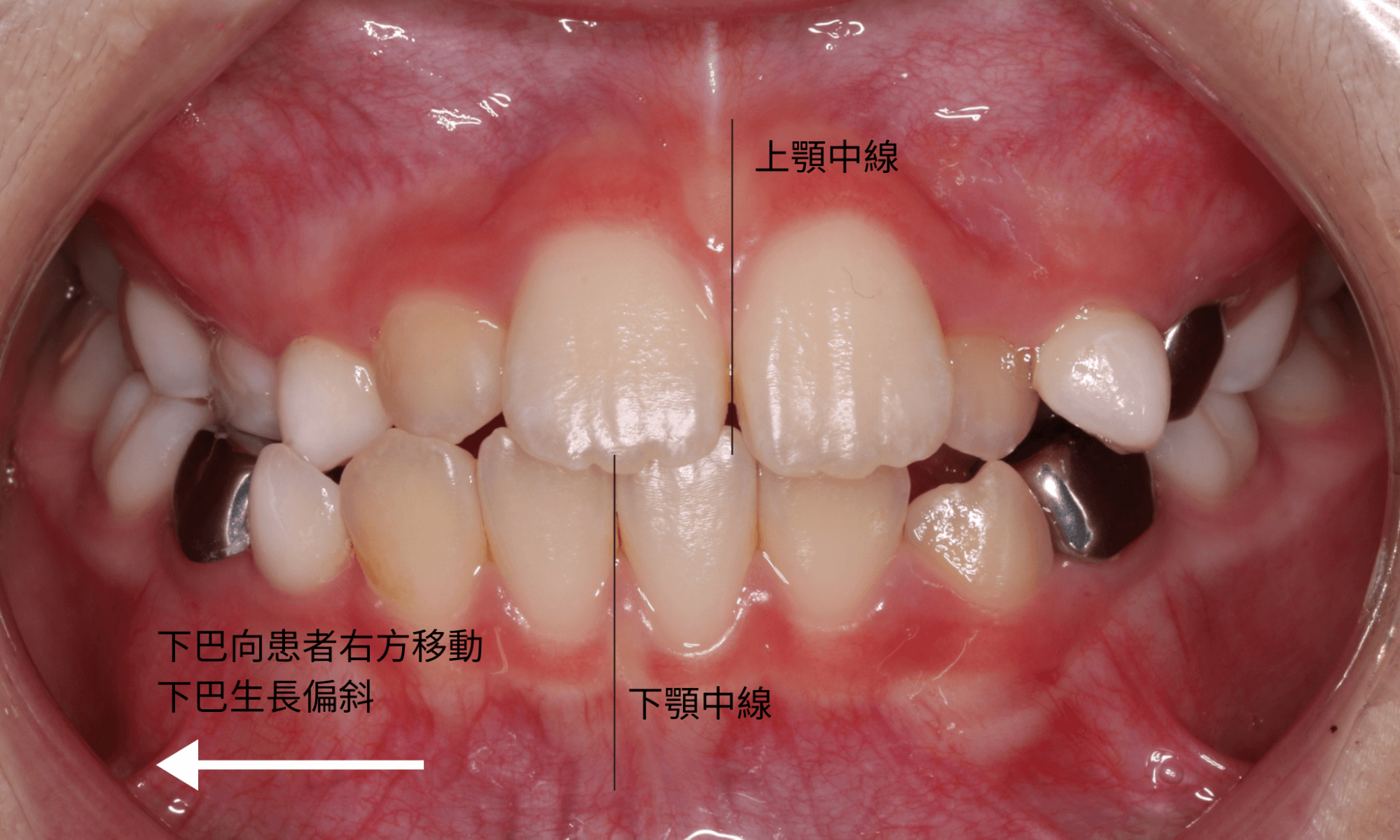 兒童牙齒矯正前有齒列不整、牙齒中線不齊、下巴生長歪斜等問題。