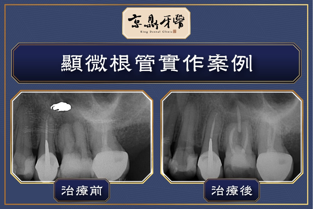 京鼎牙醫：顯微根管案例解析