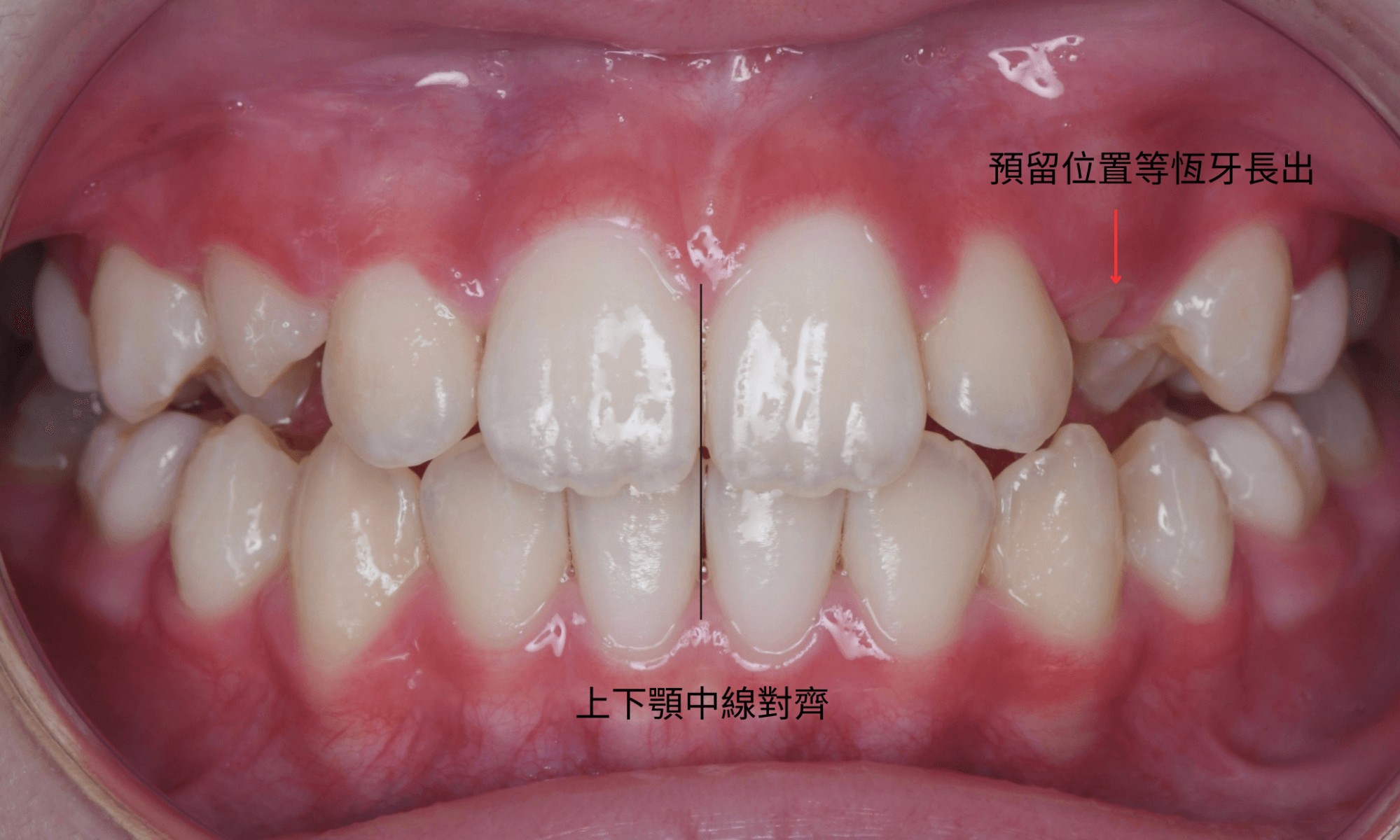 兒童牙齒矯正後，齒列到達理想狀態