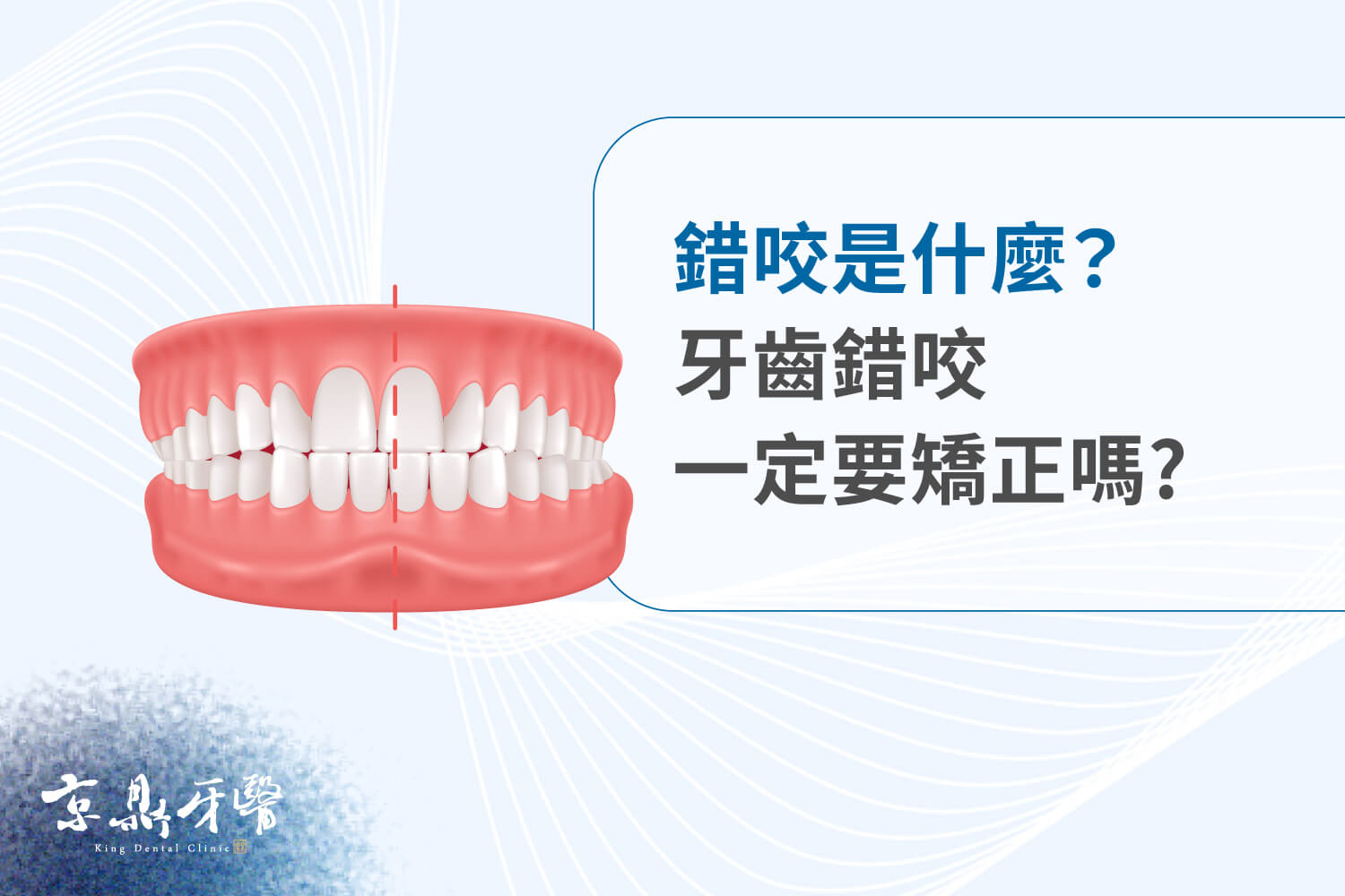 錯咬是什麼