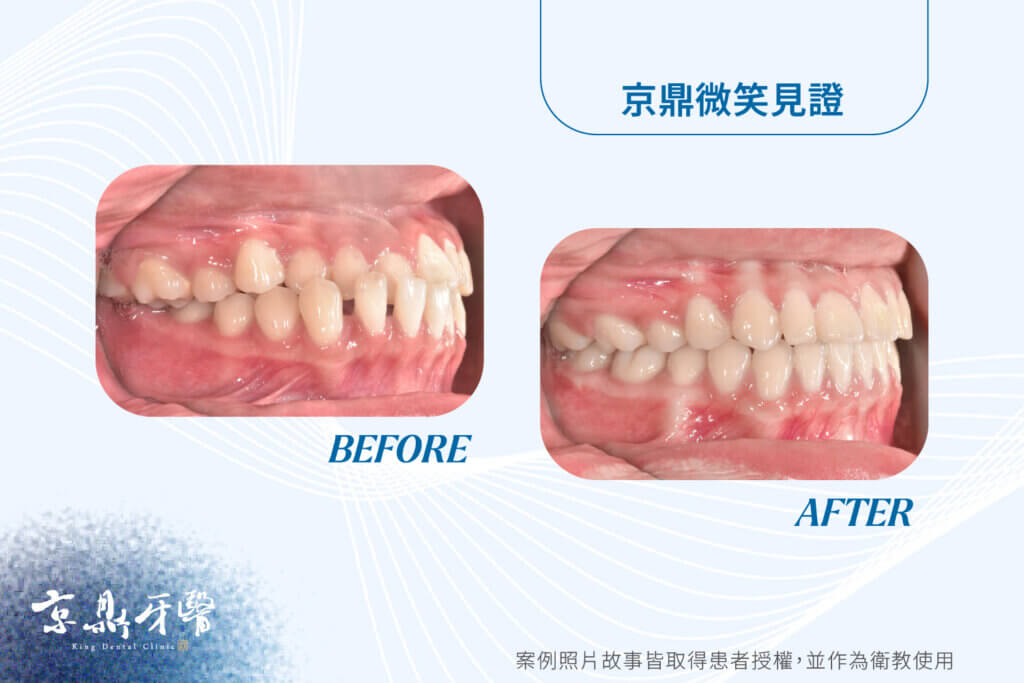 牙齒上下交錯怎麼辦,錯咬矯正