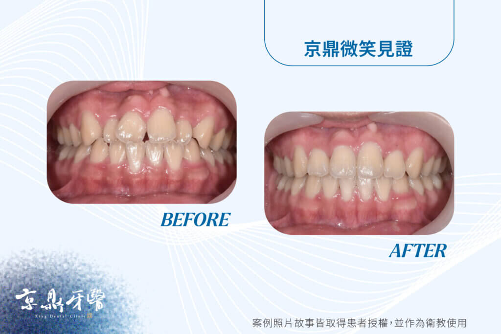 牙齒不整齊減少牙齒壽命