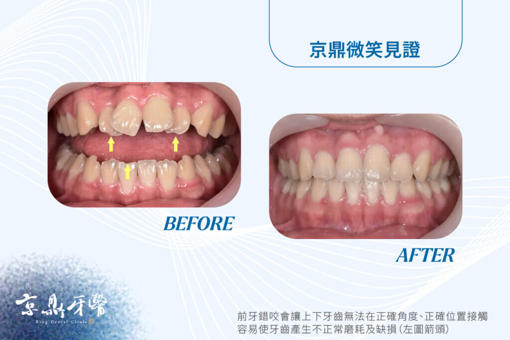 牙齒不整齊減少牙齒壽命