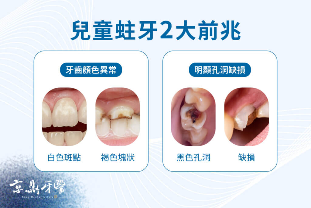 兒童蛀牙2大前兆:外觀顏色異常或孔洞缺損