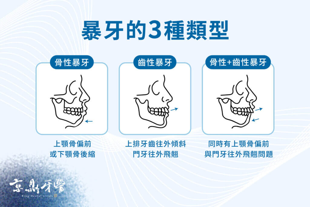 兒童暴牙的類型:骨性暴牙、齒性暴牙、骨性+齒性暴牙