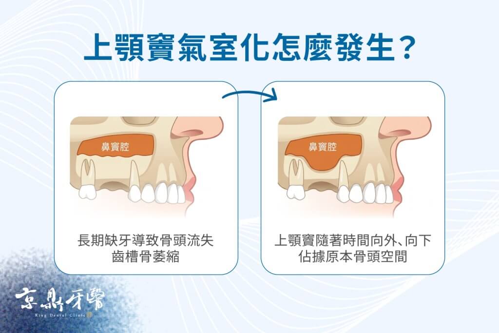長期缺牙導致齒槽骨萎縮,上顎竇隨著時間向外、向下佔據原本骨頭空間