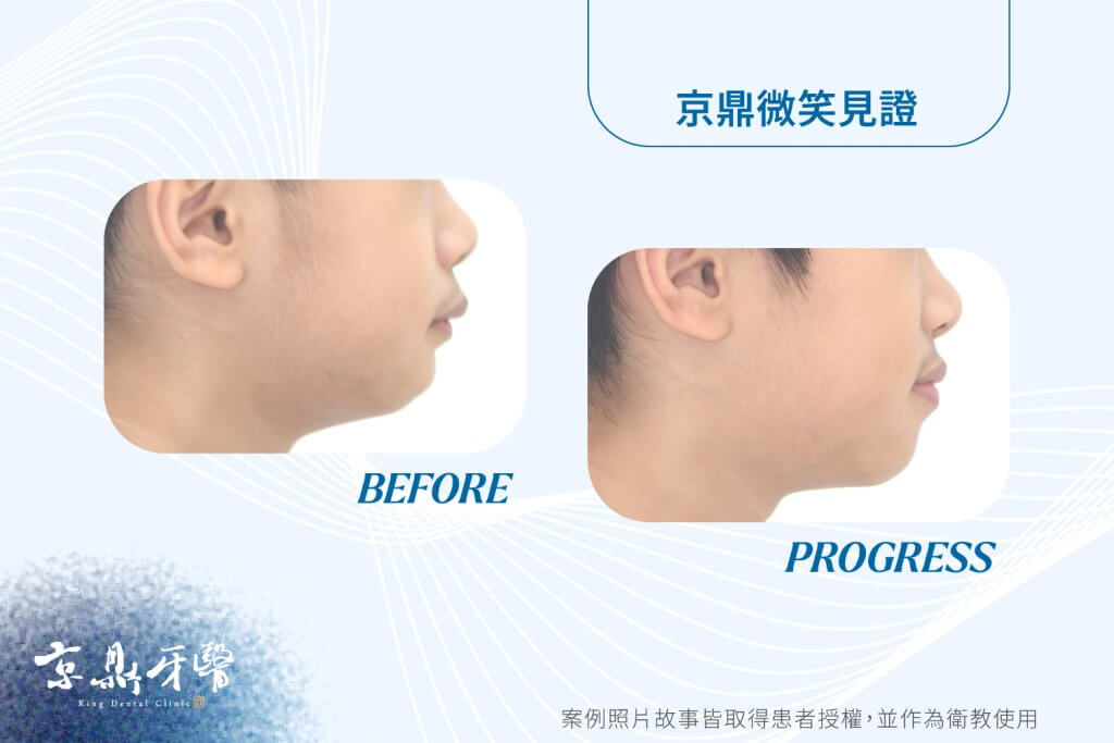 不配合怎麼早期矯正案例1