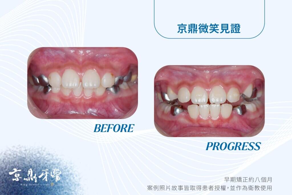 不配合怎麼早期矯正案例2