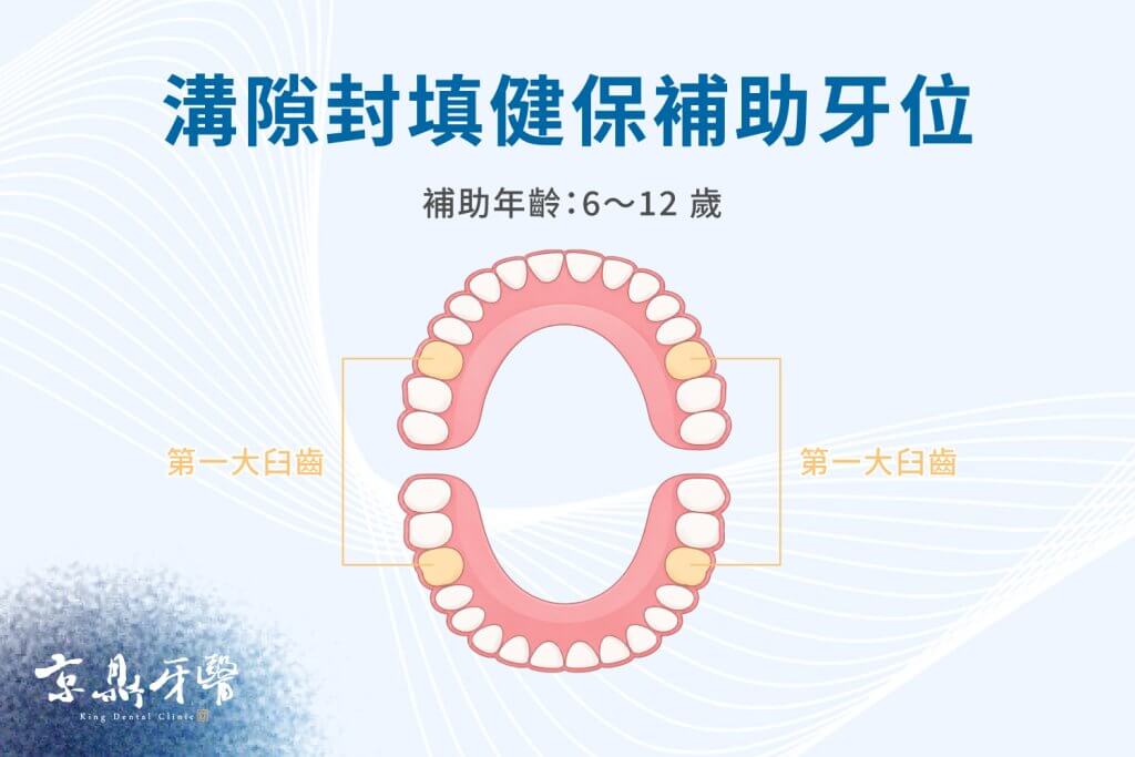 健保提供年滿 6 歲至 12 歲的國小學童恆牙第一大臼齒窩溝封填服務