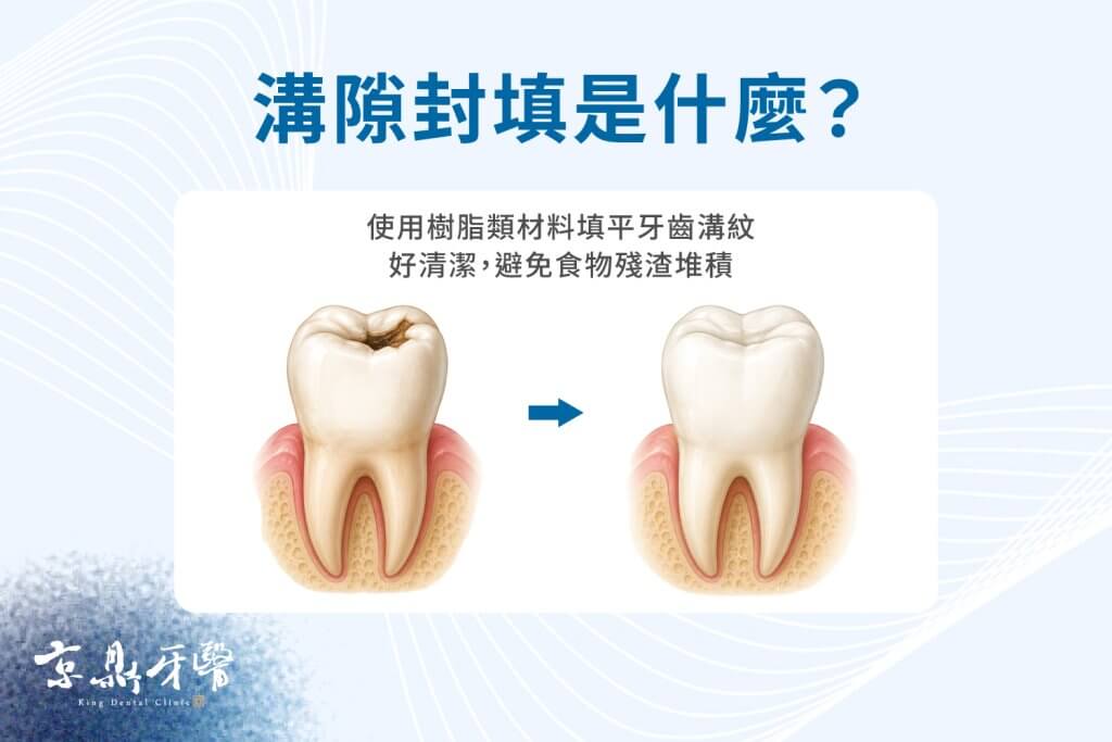 使用樹脂材料填平牙齒溝紋,使牙齒好清潔,避免食物殘渣堆積